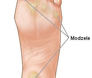 Modzele – stwardnienia na stopach – jak je zwalczyć?